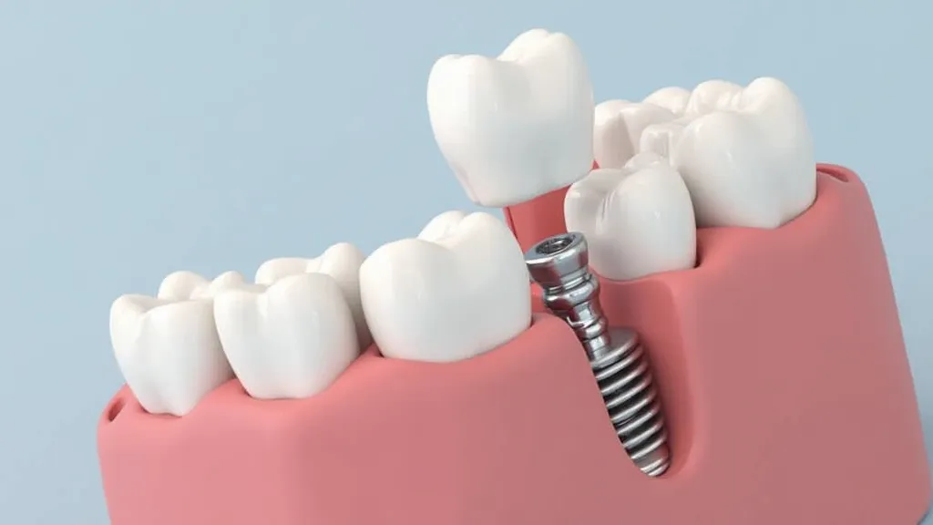 Affordable Full Mouth Dental Implants Explained